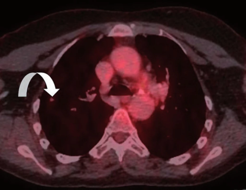 PET/CT zobrazení plicního non-avidního ložiska z listopadu 2014.