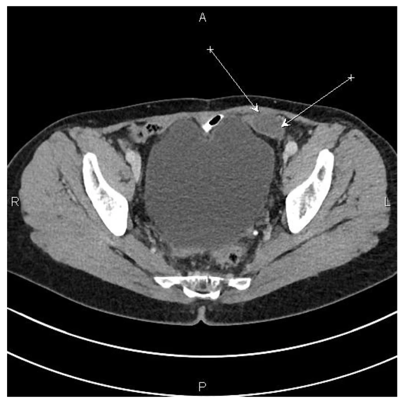 CT nález – šipky označují ložisko na pánevním peritoneu
vlevo<br>
Fig. 1: CT scan – arrows indicate the focus in the left pelvic
peritoneum