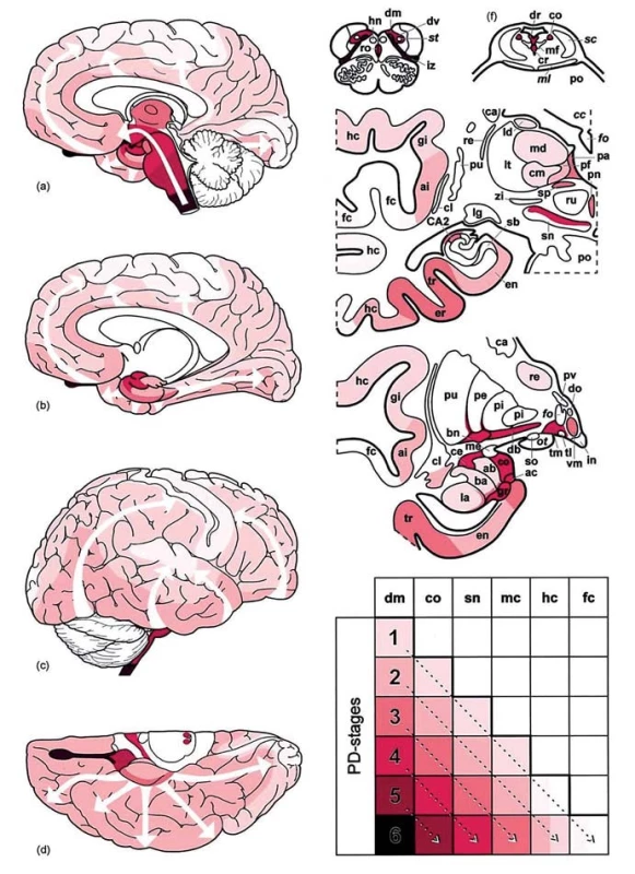 Progresia patologických zmien u PCh.
Stupne intenzity červenej farby udávajú stupeň postihnutia mozgu typickou tzv. Lewy patológiou, šípky znázorňujú šírenie patologických zmien v čase a centrifugálny smer od mozgového kmeňa (a) do limbického a frontoorbitálného kortexu (b) a neskôr difúzne (c, d).
dm – dorzálne motorické jadro n. vagus, co – locus coeruleus; sn – substantia nigra, mc – predný frontoorbitálny a temporálny mezokortex, hc – senzorický asociačný a prefrontálny kortex, fc – frontálny kortex vrátane primárneho senzomotorického kortexu, PD-stages – štádia PCh podľa Braaka (1–6) (prevzaté z [17]).
Fig. 4. Progression of pathological changes in the PD.
Intensity of the red color indicates the level at which the brain is affected with so-called typical Lewy pathology; the arrows show the spread of pathological changes over time and centrifugal direction from the brain stem (a) to the limbic and frontoorbital cortex (b), follow by diffuse spread (c, d).