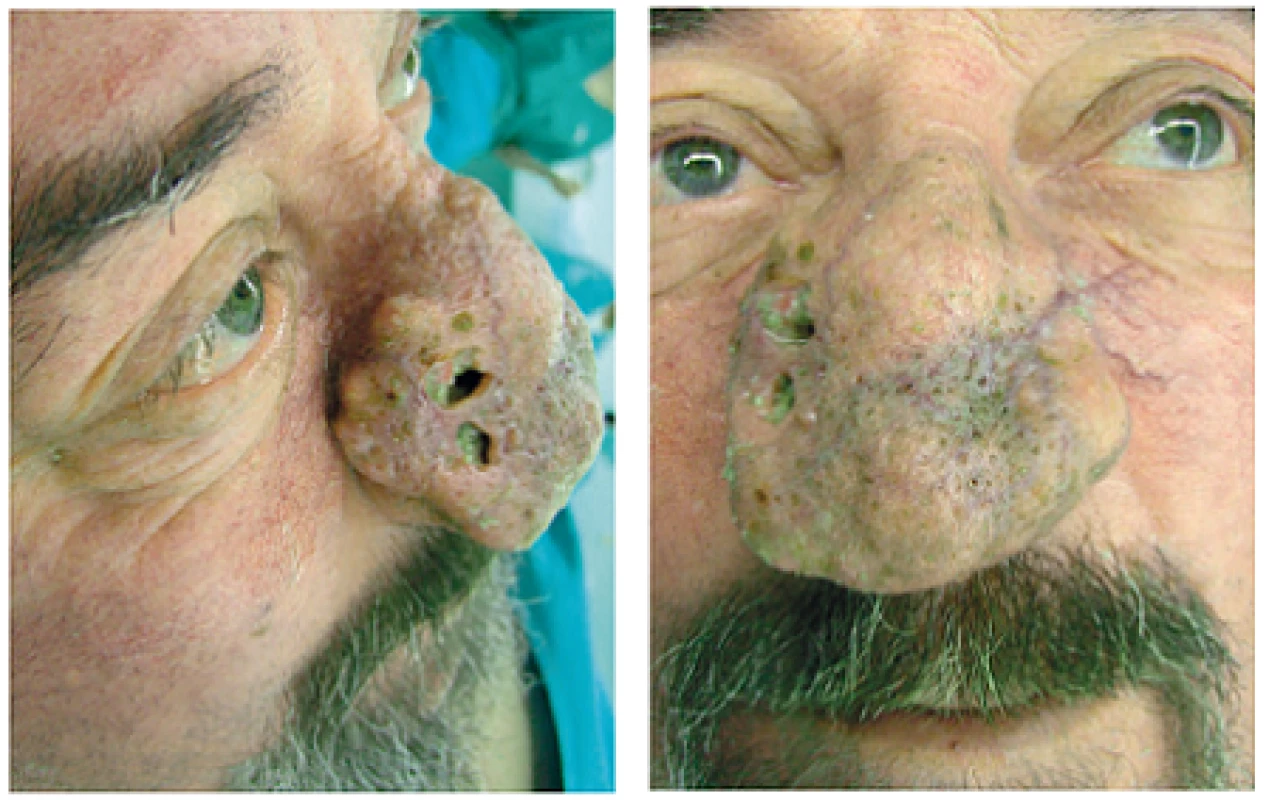 Pacient s epidermoidným karcinómom kože v teréne rinofymy.