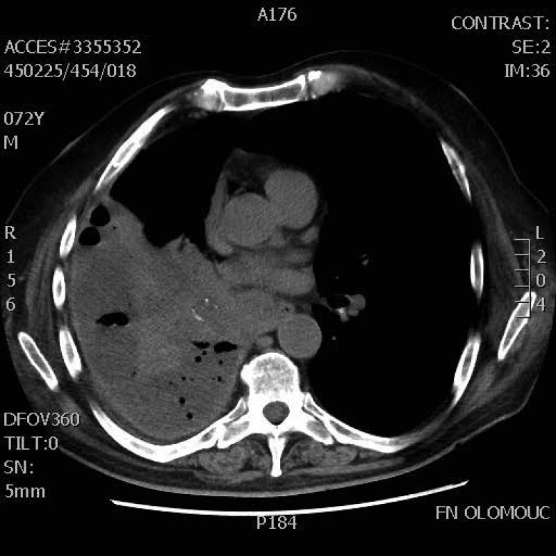 CT hrudníku – empyém