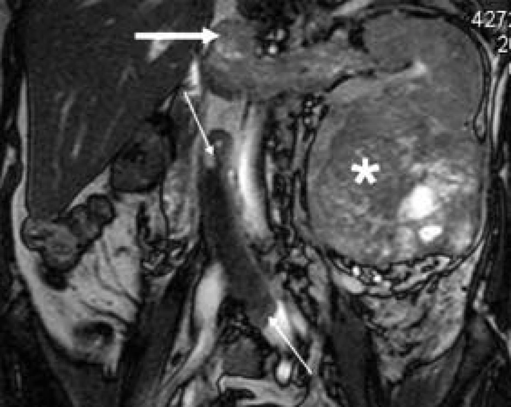 Nádorová trombóza Grawitzova nádoru levé ledviny (hvězdička) v levé ledvinné žíle, zasahující až do dolní duté žíly (silná šipka). Oblenění krevního toku v dolní duté žíle vedlo ke vzniku druhého, krevního trombu, který se liší díky jinému složení intenzitou signálu od nádorového trombu.