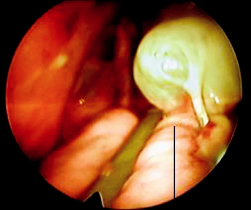 Endoskopická resekce plicní buly
Fig. 2. Endoscopic resection of a pulmonary bule