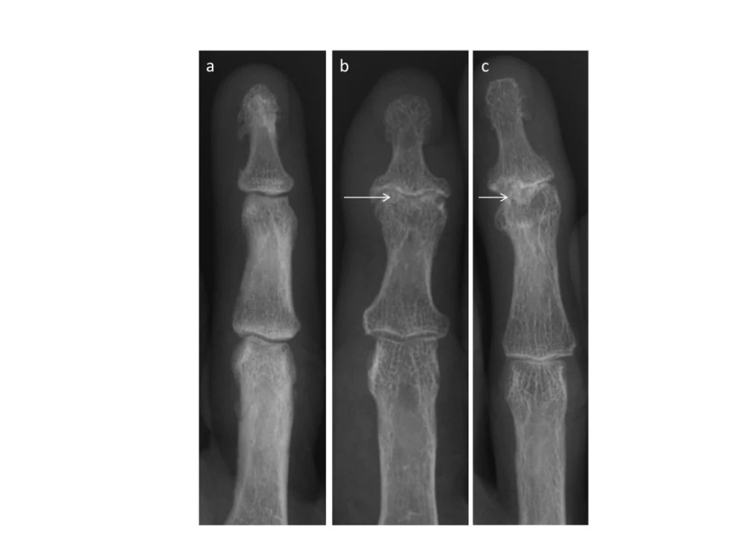 Rentgenové snímky osteoartrózy (OA) ručních kloubů. Počínající Heberdenovy uzly a zúžení kloubní štěrbiny v proximálním interfalangeálním kloubu (a). Erozivní OA postihující distální interfalangeální klouby s charakteristickým projevem centrální eroze (křídla racka) a kolapsem subchondrální kosti (b, c) &lt;em&gt;(z archivu autora).&lt;/em&gt;