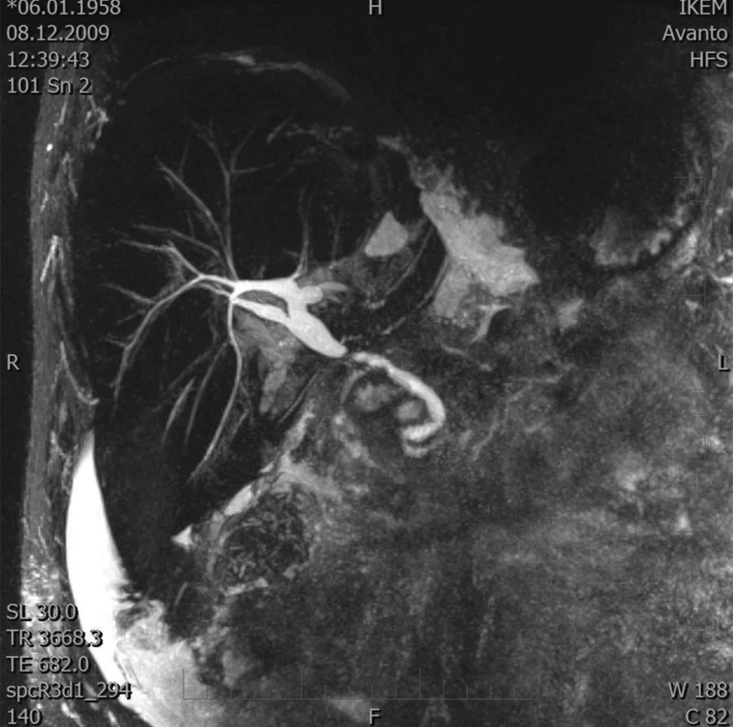 MRCP – stenóza žlučovodu
Fig. 1. MRCP – biliary duct stenosis