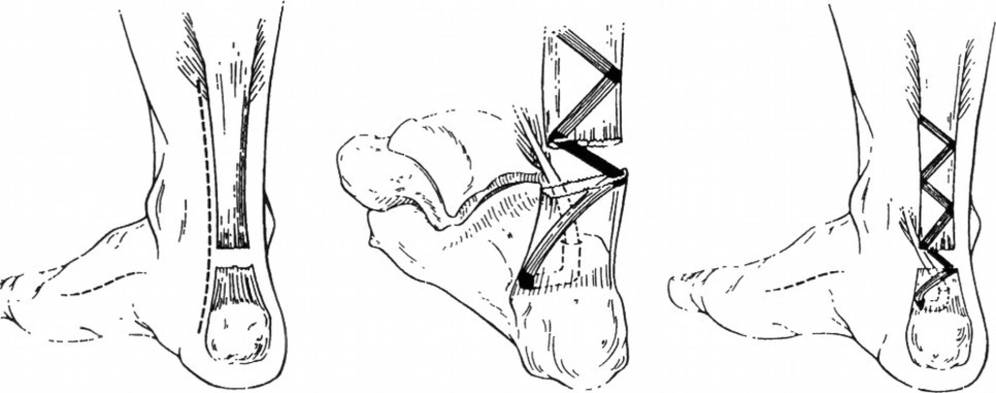 Plastika dle Keith L. Wapnera [15]
(Volně podle Wapner, K.L., Pavlock, G.S., Hecht, P.J., Naselli, F., Walther, R. Repair of chronic Achilles tendon rupture with flexor hallucis longus tendon transfer. Foot Ankle, 14, 443–449, 1993)