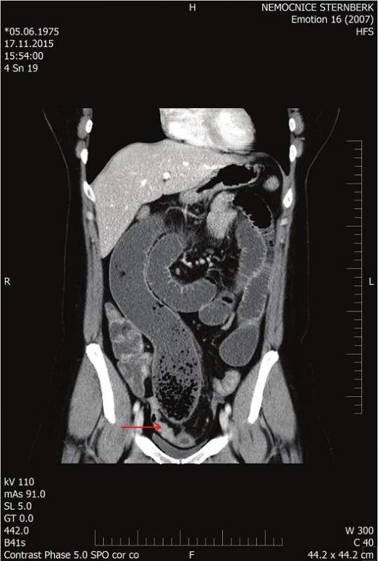 CT dilatované tenké kličky
Fig. 1: CT of the dilated small bowel loop