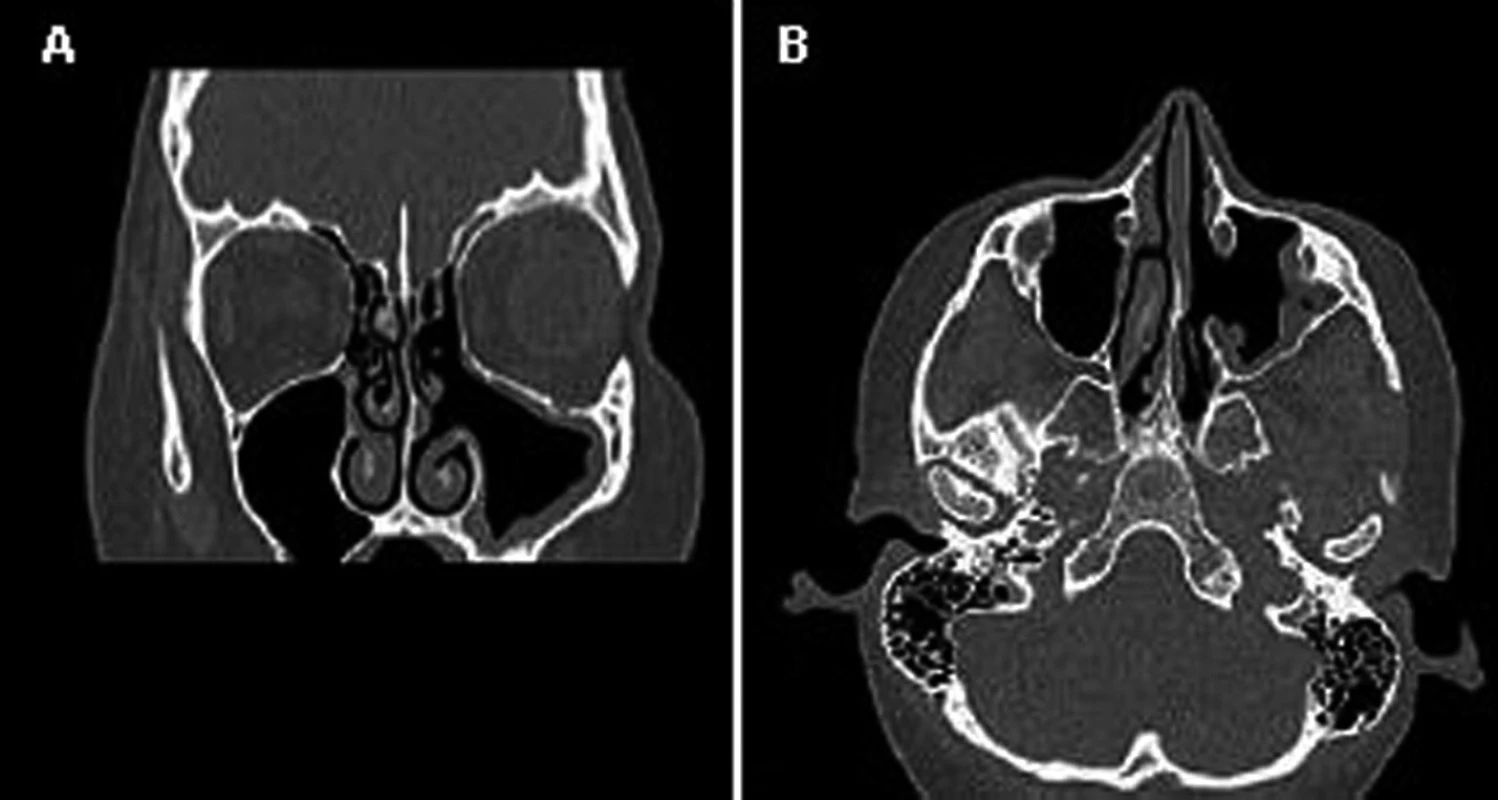 Koronární (A) a axiální (B) projekce na CT VDN dokumentující příznivý výsledek v oblasti primárního zánětlivého ložiska – široká drenáž /antrostomie a přední ethmoidektomie/ (21. den po primární operaci)