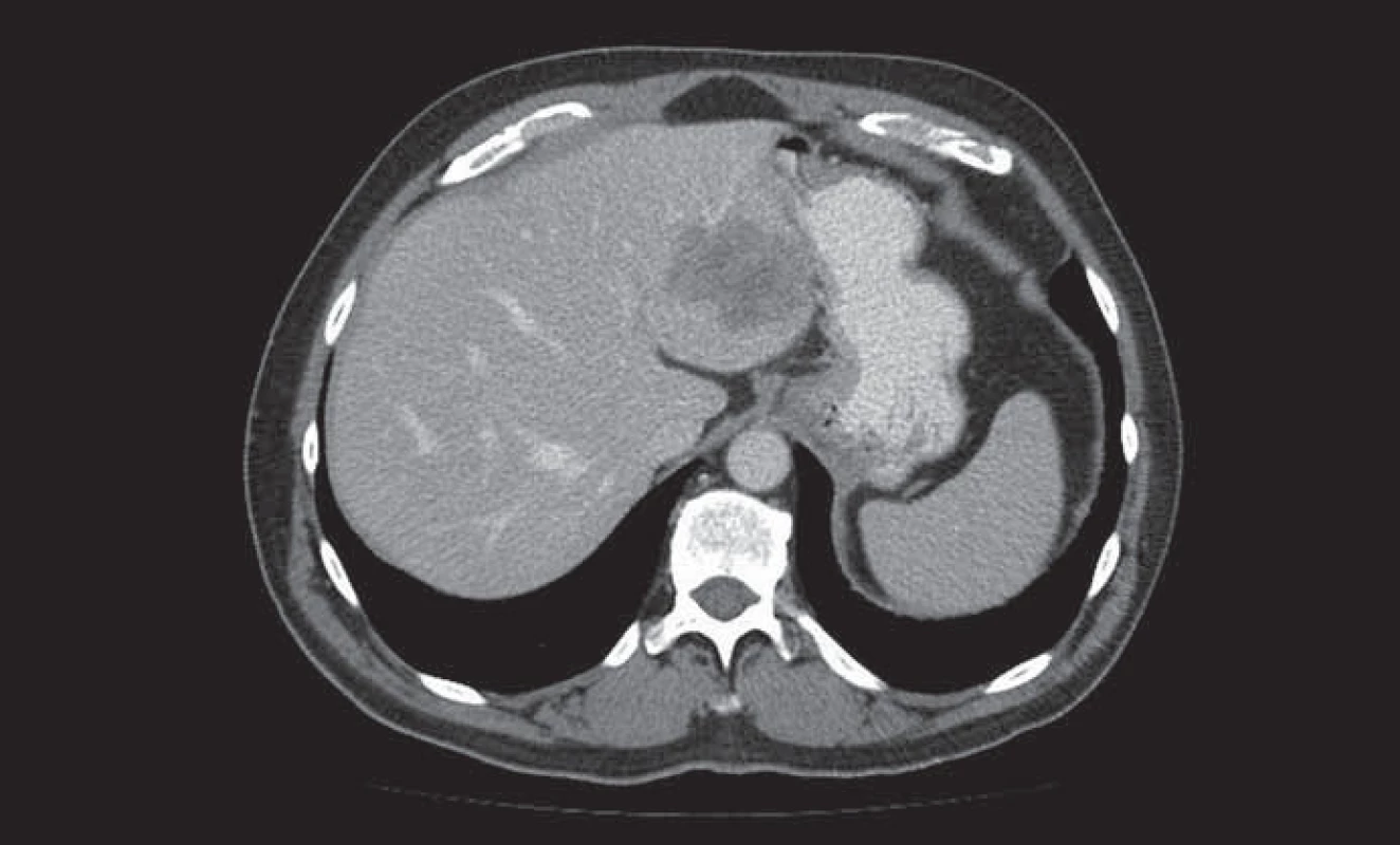 Metastáza kolorektálního karcinomu v levém laloku jater.