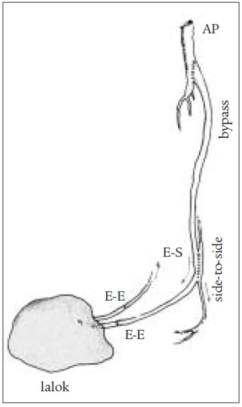 Schéma kombinovaného výkonu se side to side anastomózou, štěp pokračuje do laloku.