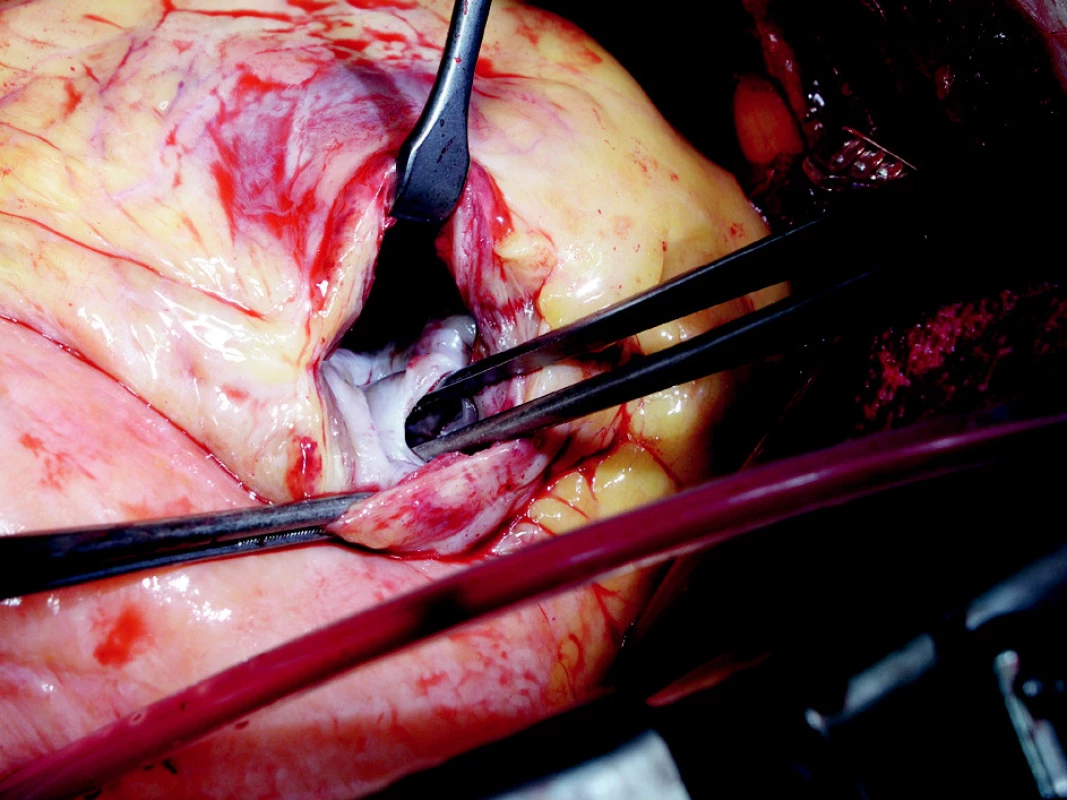 Peroperačný nález defektu hrotovej časti komorového septa
Fig. 1. Intraoperative finding of a defect in the apical part of the ventricular septum 