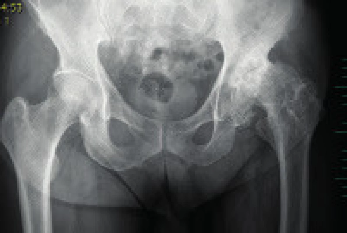 RTG pánve dospělého pacienta se sekundární koxartrózou vlevo po proběhlé Perthesově chorobě v dětství.
Fig. 7. Pelvis X-ray of an adult with secondary hip osteoarthritis of the left hip joint as a result of Perthes disease in childhood.
