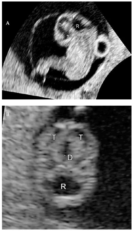 UZ zobrazení embrya v 9. týdnu gestace. Mediosagitální řez embryem (A), transverzální řez CNS (B). CRL = 17,7 mm.
T – telencefalon, D – diencefalon, M – mezencefalon, R – rombencefalon