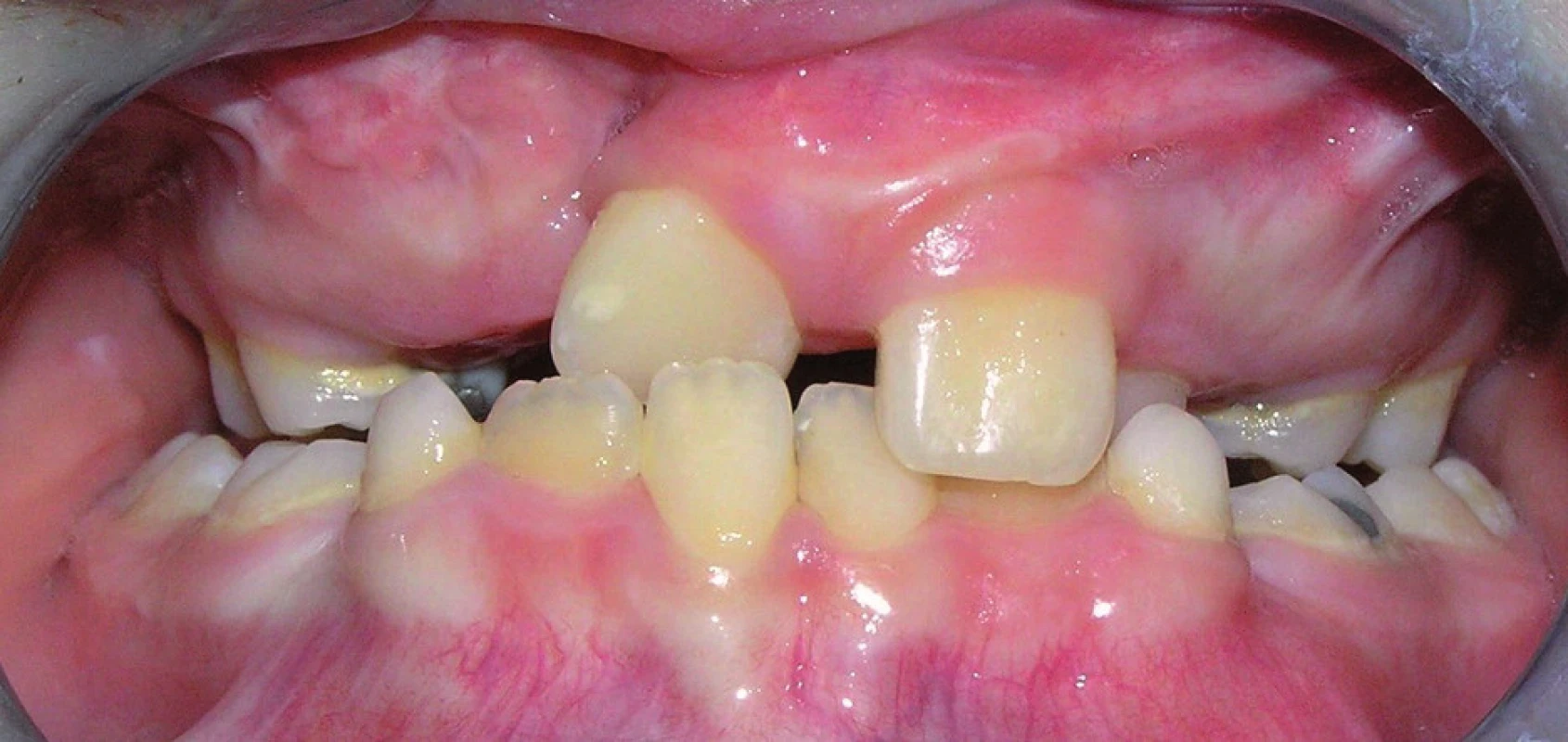 Skus chlapce s pravostranným celkovým rozštěpem ve věku 8 let a 5 měsíců. V laterálních úsecích chrupu je zkřížený skus, zuby 11 a 22 prořezaly do zákusu.