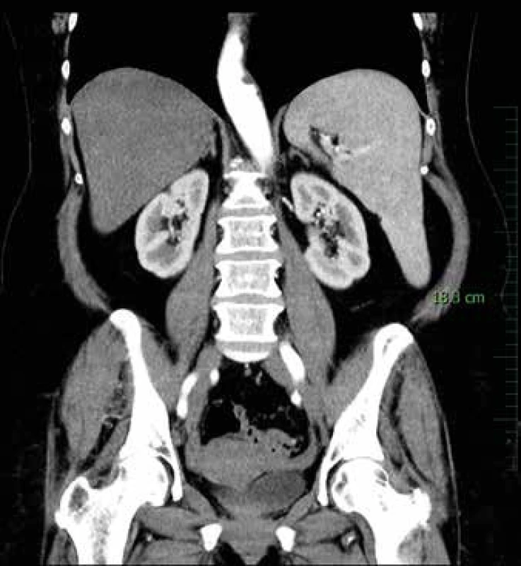 CT břicha s kontrastní látkou – venózní fáze