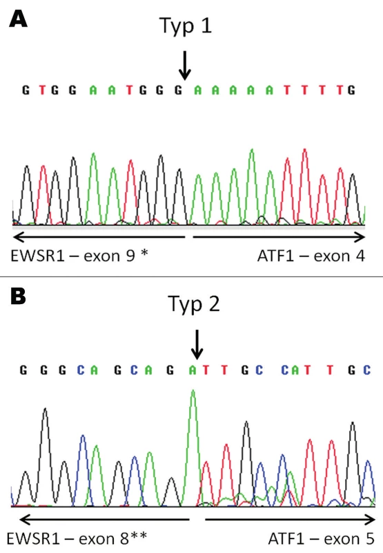 Konfirmace průkazu fúzního transkriptu EWSR1-ATF1 pomocí sekvenování. V tumoru nalezeny fúzní transkripty typu 1 (A) a typu 2 (B). Šipky vyznačují místa fúze.