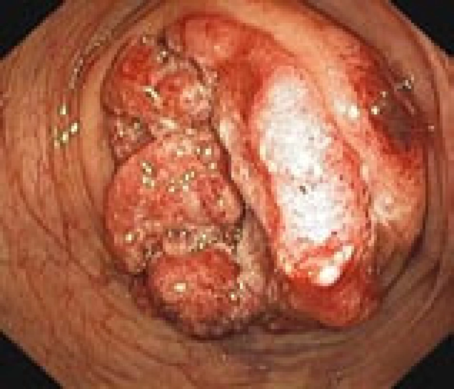 Pokročilý karcinom tračníku v endoskopickém obraze během kolonoskopie (vlastní materiál).