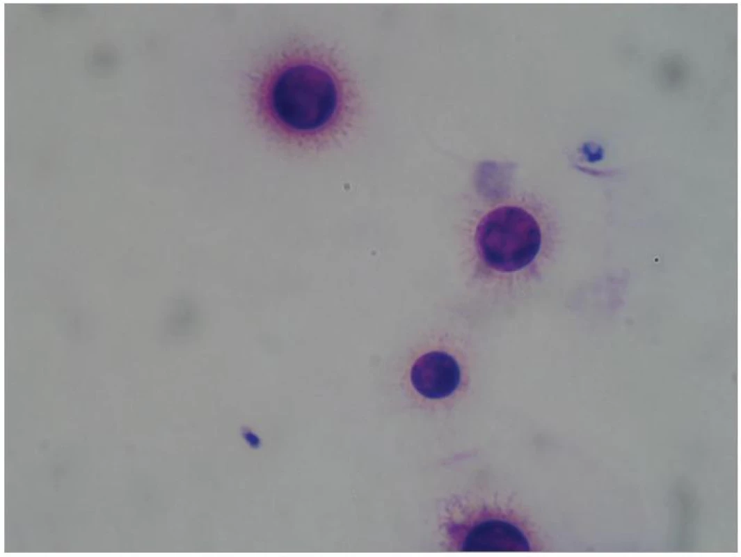 Cryptococcus neoformans v cystospinovém preparátu (barvení Diff-Quik Medion Diagnostics; zvětšení 1000krát).