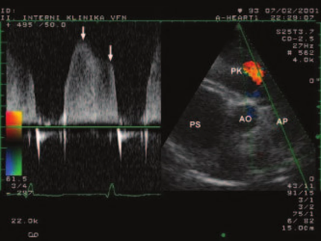 Kontinuálně dopplerovský záznam pulmonální regurgitace s vyznačením vrcholového a telediastolického gradientu (šipky)