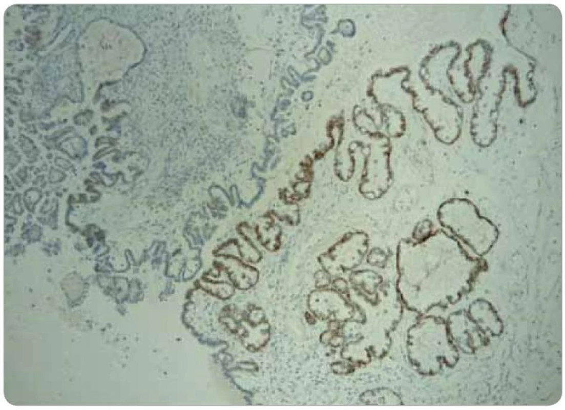 Obraz fokální cytoplazmatické pozitivity MRP3.