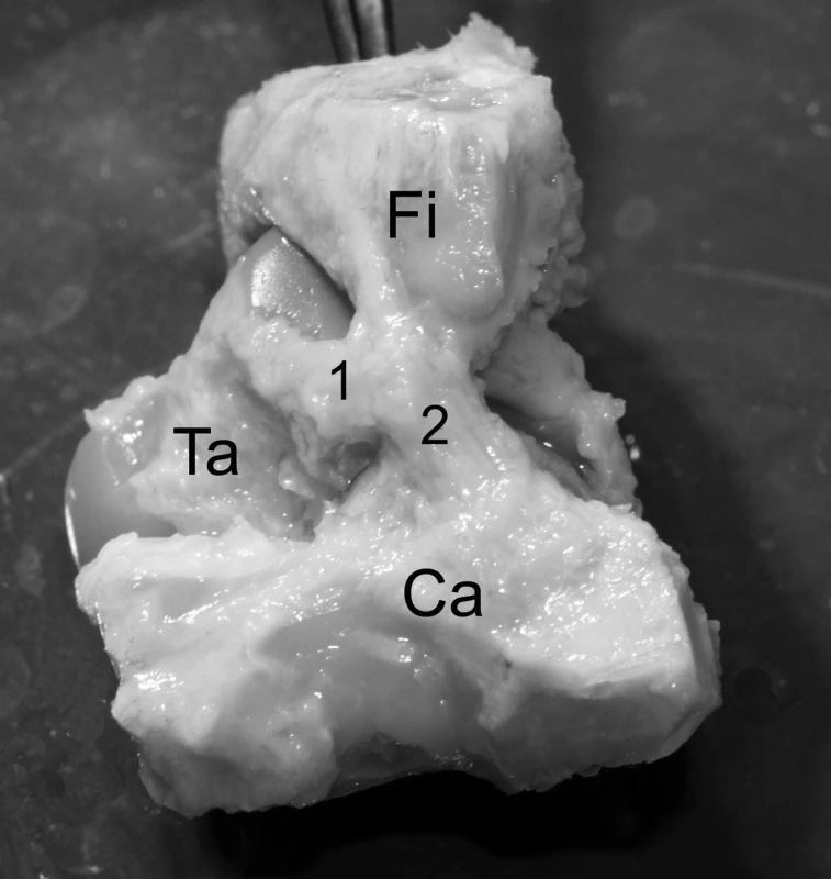 Pohled na laterální plochu hlezenního kloubu v prenatálním období. 1 – lig. fibulotalare ant. 2 – lig. fibulocalcaneare, Ca – calcaneus, Fi – fibula, Ta – talus, Ti – tibia