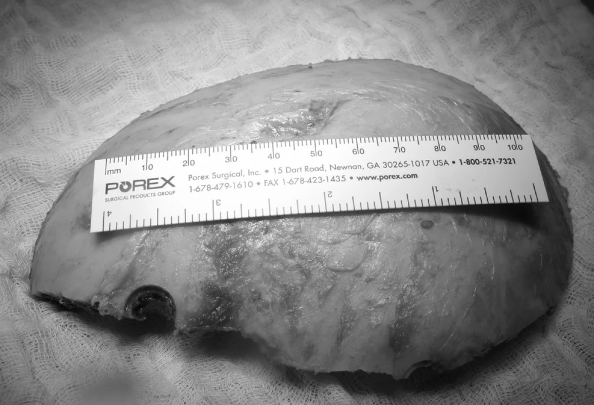 Odklopený kostní lalok s měřítkem velikosti