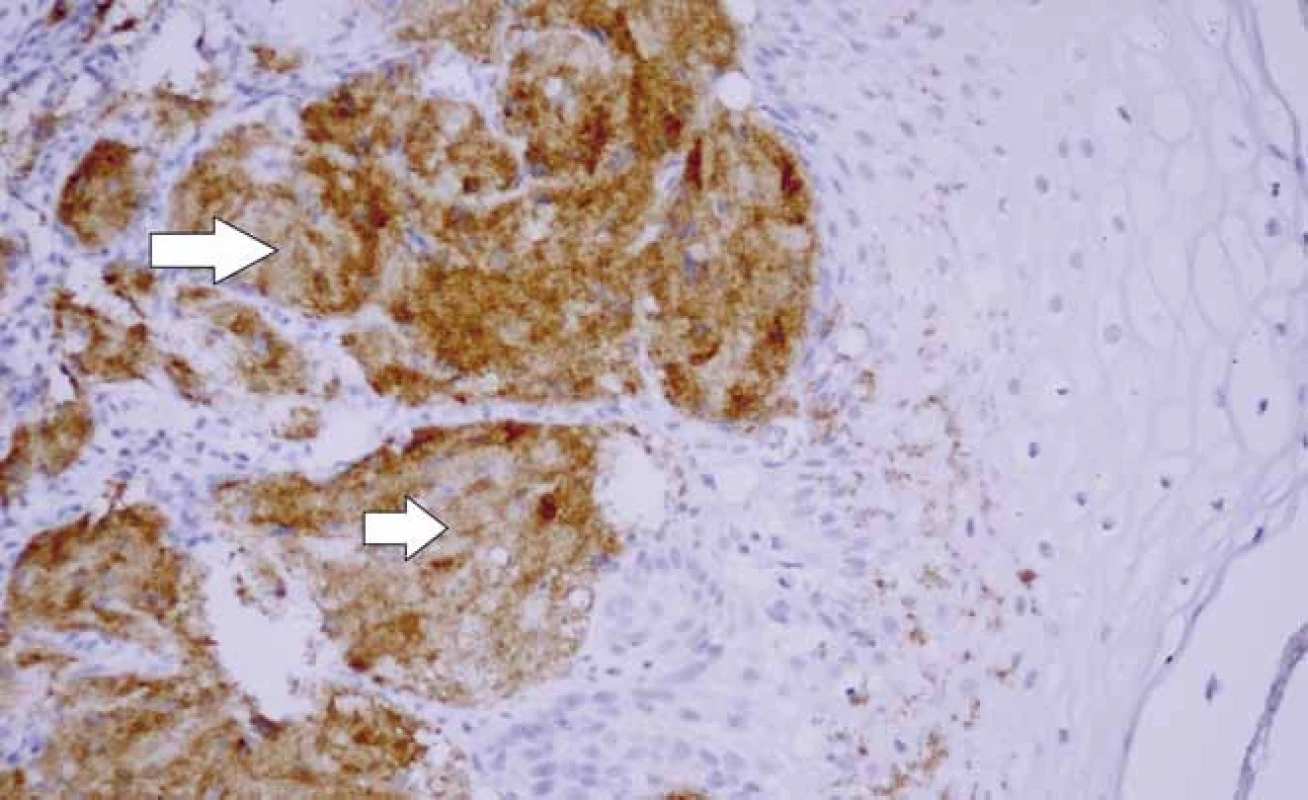 Histochémia granulárnobunkového tumoru prezentovaného pacienta – nádorové bunky (šípka) boli S100&lt;sup&gt;+&lt;/sup&gt;(A), CD68&lt;sup&gt;+&lt;/sup&gt; (B) a vykazovali aj pozitivitu na inhibín (C), IHC Ab-Px. A. S100 200×, B. CD68 200×, C. inhibín 200×.
Fig. 4. Histochemistry of granular cell tumour in the presented patient – tumour cells (arrow) were S100+ positive (A), CD68+ positive (B) and inhibin positive (C), IHC Ab-Px. A. S100 ×200, B. CD68 ×200, C. inhibin ×200.