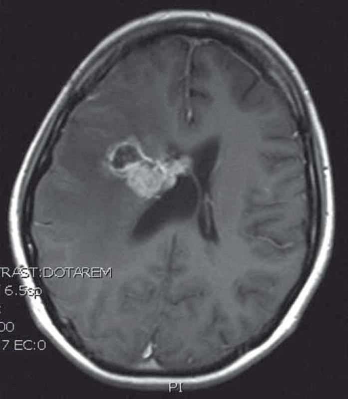 T1 vážený MRI obraz recidivy intraventrikulárního sarkomu.