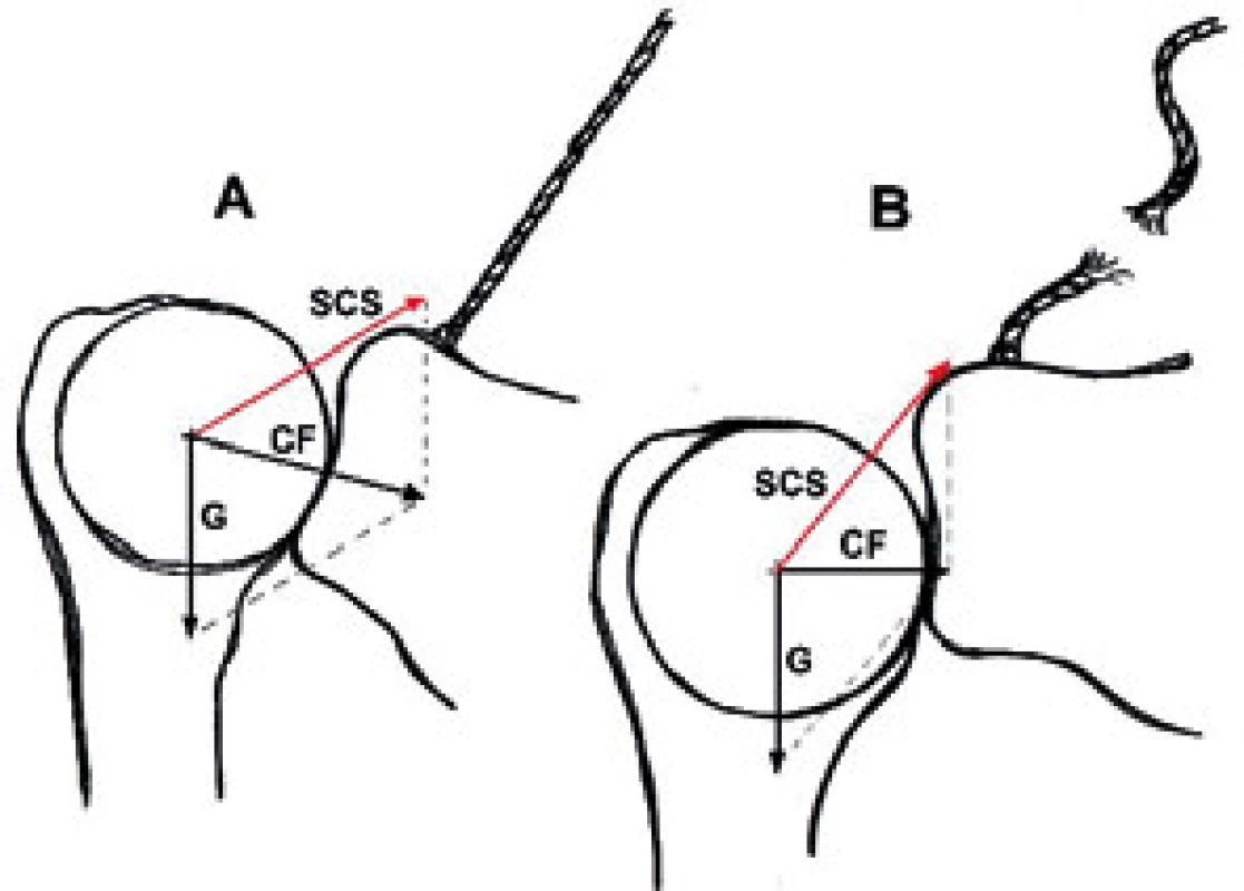 Klidové postavení glenoideální jamky v GH (A – fyziologie, B - porucha).