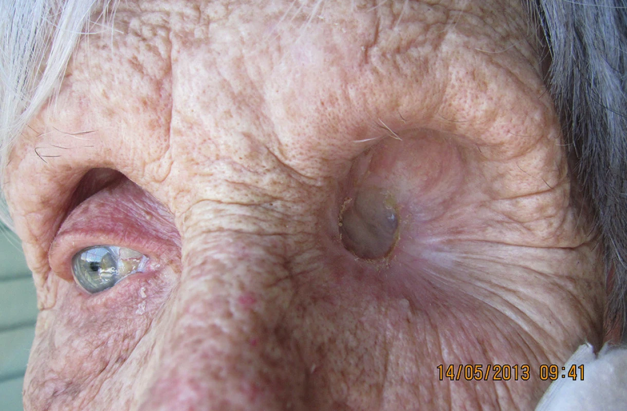 Detail očnice 1 rok po exenterácii (5/2013), bez recidívy malígneho melanómu
