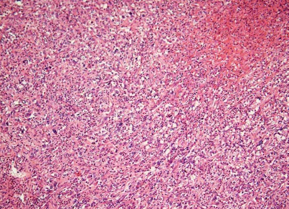 Histiocytární sarkom sleziny (barvení hematoxylin-eozin). Na snímku je patrné, že struktura sleziny je setřená difúzní nádorovou infiltrací, která ložiskově nekrotizuje (vpravo nahoře).