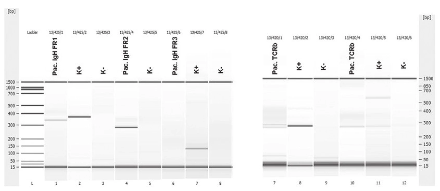Pacient 2. Heteroduplexní analýza (Bioanalyzér 2100) klonálních přestaveb IgH (IgH FR1 a IgH FR2) a TCRbeta, K+ pozitivní kontrola, K- negativní kontrola (polyklonální DNA).