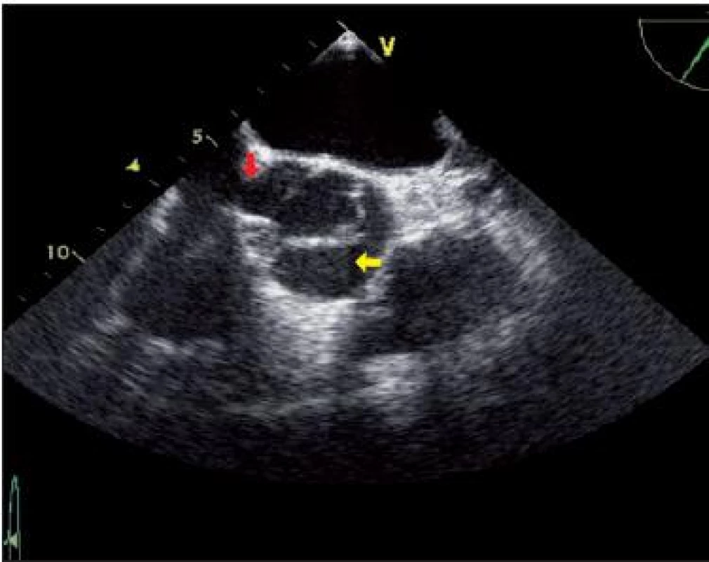 Transezofageální ultrazvukové vyšetření srdce v krátké ose ve střední fázi systoly. Z vyšetření je zřejmé, že se jedná o bikuspidální aortální chlopeň, typ A-P. Žlutou šipkou je označen větší fúzovaný cíp, červenou šipkou menší „zadní“ cíp.