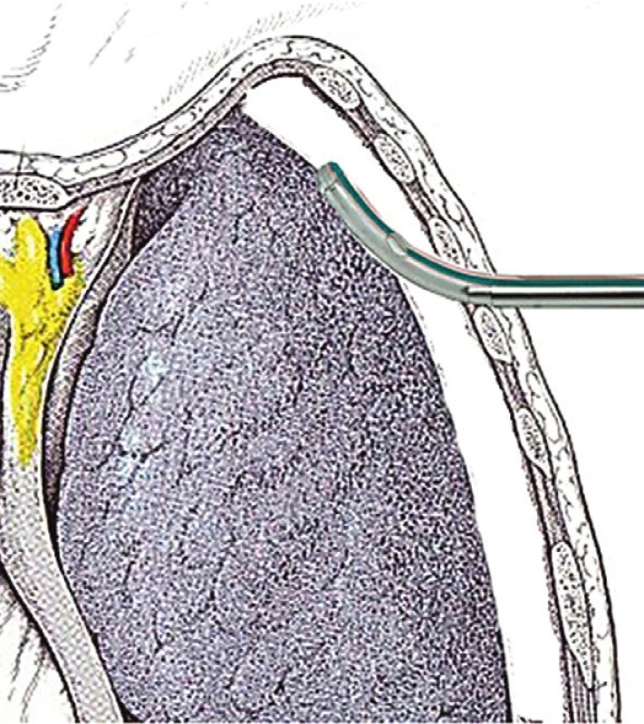 Schéma zavedení hrudního drénu
Fig. 4: Diagram of chest drain insertion