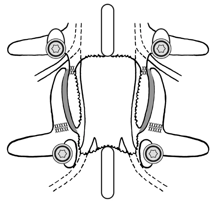 Schéma dekomprese laminektomií se zachováním hypertrofických meziobratlových kloubů segmentu LS páteře včetně minimálně 5 mm širokých kostních můstků processus articulares (označeno šrafovaně) Na úrovni pediklů jsou hlavice TP šroubů.
Fig. 1: Scheme of decompression of the lumbosacral spinal canal by laminectomy with only partial facetectomy of the hypertrophic intervertebral joint´s Bone bridges of the articular process with minimal a width of 5 mm were preserved. At the places of the pedicles are heads of transpedicular (TP) screws.