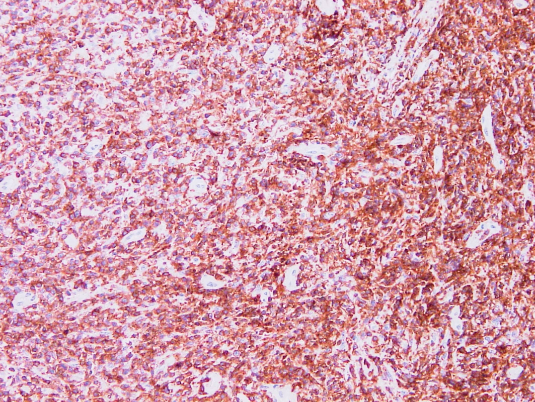 Vzorek z 3. bioptického odběru – AITL
CD5 pozitivita nádorových buněk, cévy jsou negativní, vzhled obdobný jako v prvním odběru.