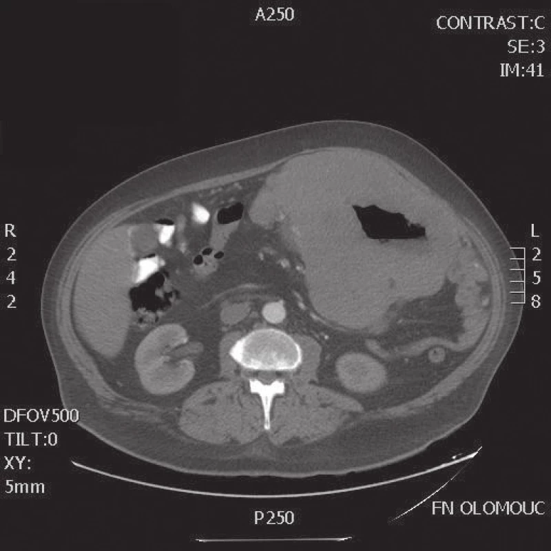 CT transverzální řez lymfomu dutiny břišní
Fig. 2: CT scan – transversal view of lymphoma in the abdominal cavity