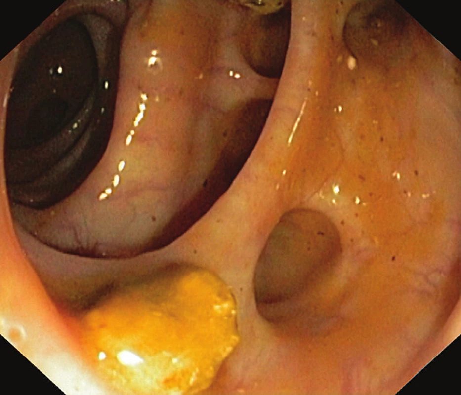Těžší divertikulóza na colon sigmoideum (jsou patrné četné objemné divertikly, v luminu tračníku je z divertiklu vypadlý fekolit)