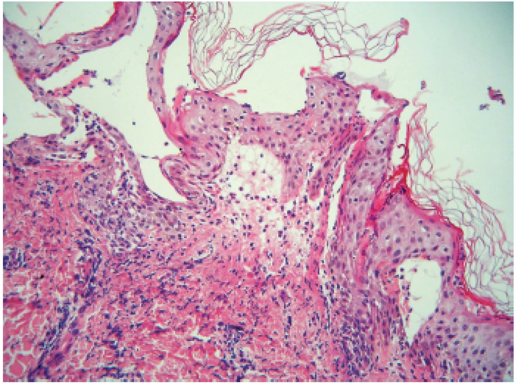 Subepidermální drobná, vertikálně protažená bula s neutrofily – obraz blízký dermatitis herpetiformis Duhring