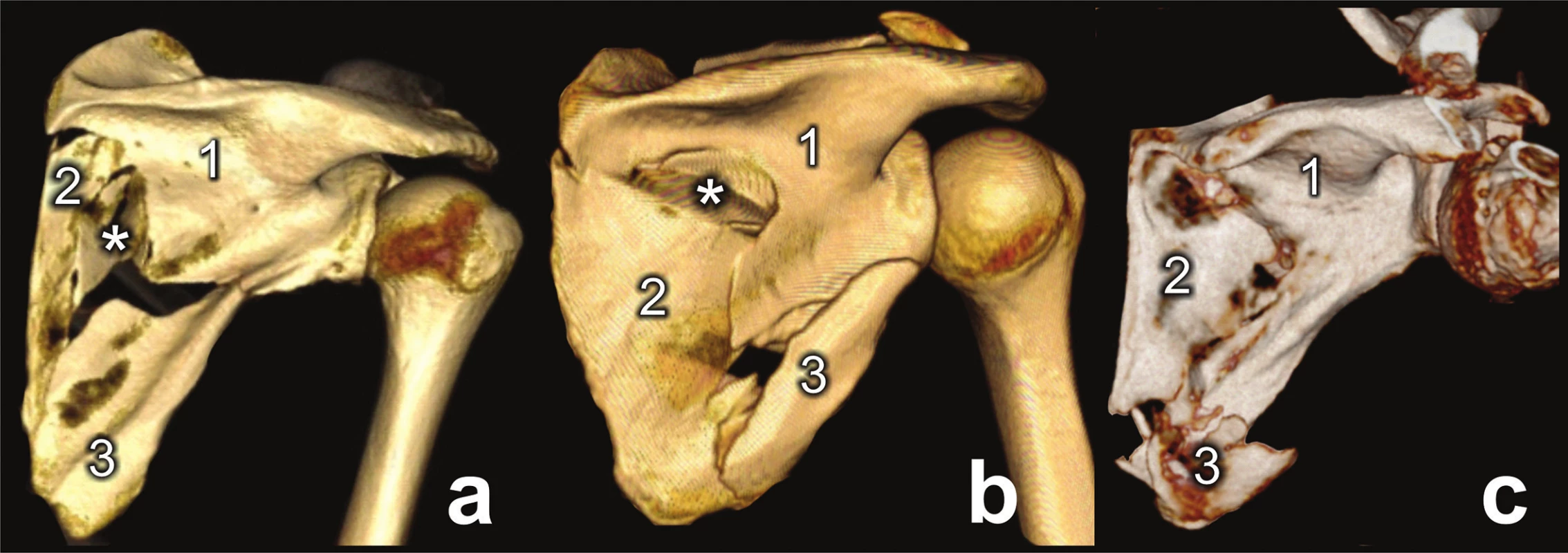 Types of three-part fracture of lateral pillar
a – large inferior angle fragment, 1− glenoid fragment, 2 – inferior angle fragment, 3 – medial border fragment; b – large inferomedial fragment, 1 – glenoid fragment, 2 – lateral border fragment, 3 – large inferomedial fragment; c – large glenoid fragment, 1 – glenoid fragment, 2 – inferior angle fragment, 3 – medial border fragment,* - intercalary fragment.