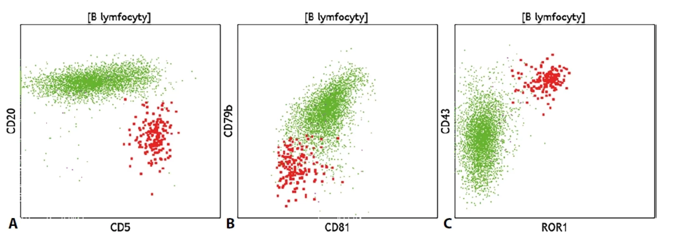 Současný nález reziduálních CLL buněk (červeně) a fyziologických B lymfocytů (zeleně); rozdílná exprese znaků (A) CD5 a CD20, (B) negativita znaků CD79b a CD81 na CLL populaci, (C) exprese molekul CD43 a ROR1 na CLL buňkách.