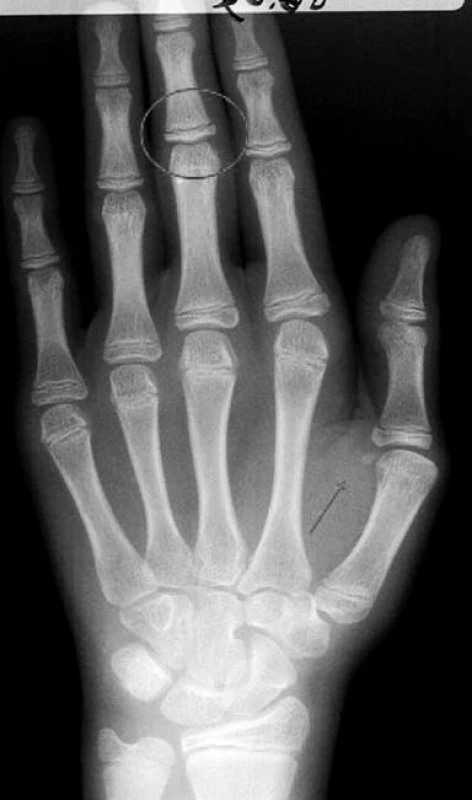 RTG ruky s označením hlavních sledovaných struktur ke stanovení skeletálního věku
