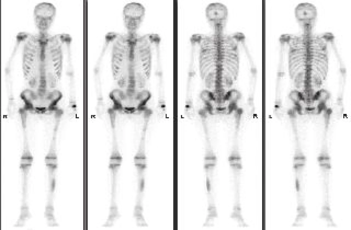 Třífázová scintigrafie skeletu metodou celotělové scintigrafie v přední a zadní projekci. Třetí (kostní fáze). Nález skvrnitě zvýšeného vychytávání v axiálním skeletu, v kalvě okcipitálně, v obou kyčelních kloubech a v levé fibule - vzhledem k věku pacientky výrazně atypický obraz.
