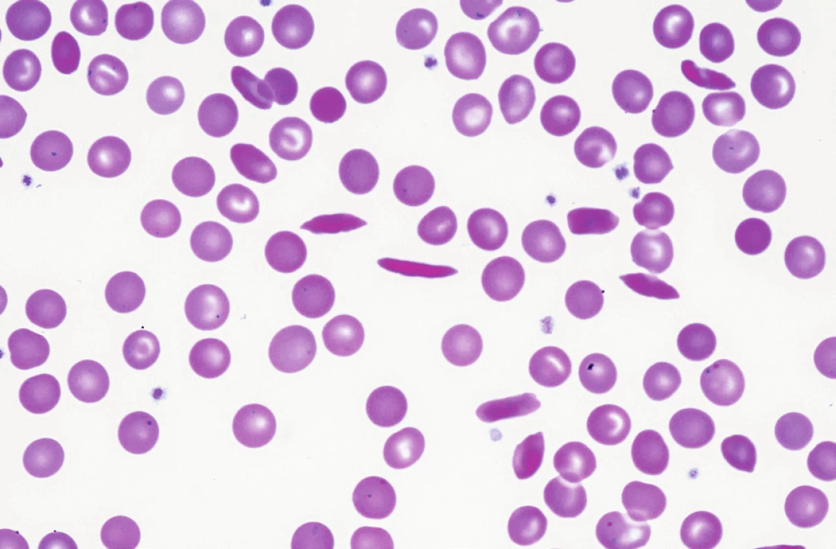 Srpkovité krvinky v periferní krvi nemocné s homozygotní formou srpkovité anémie