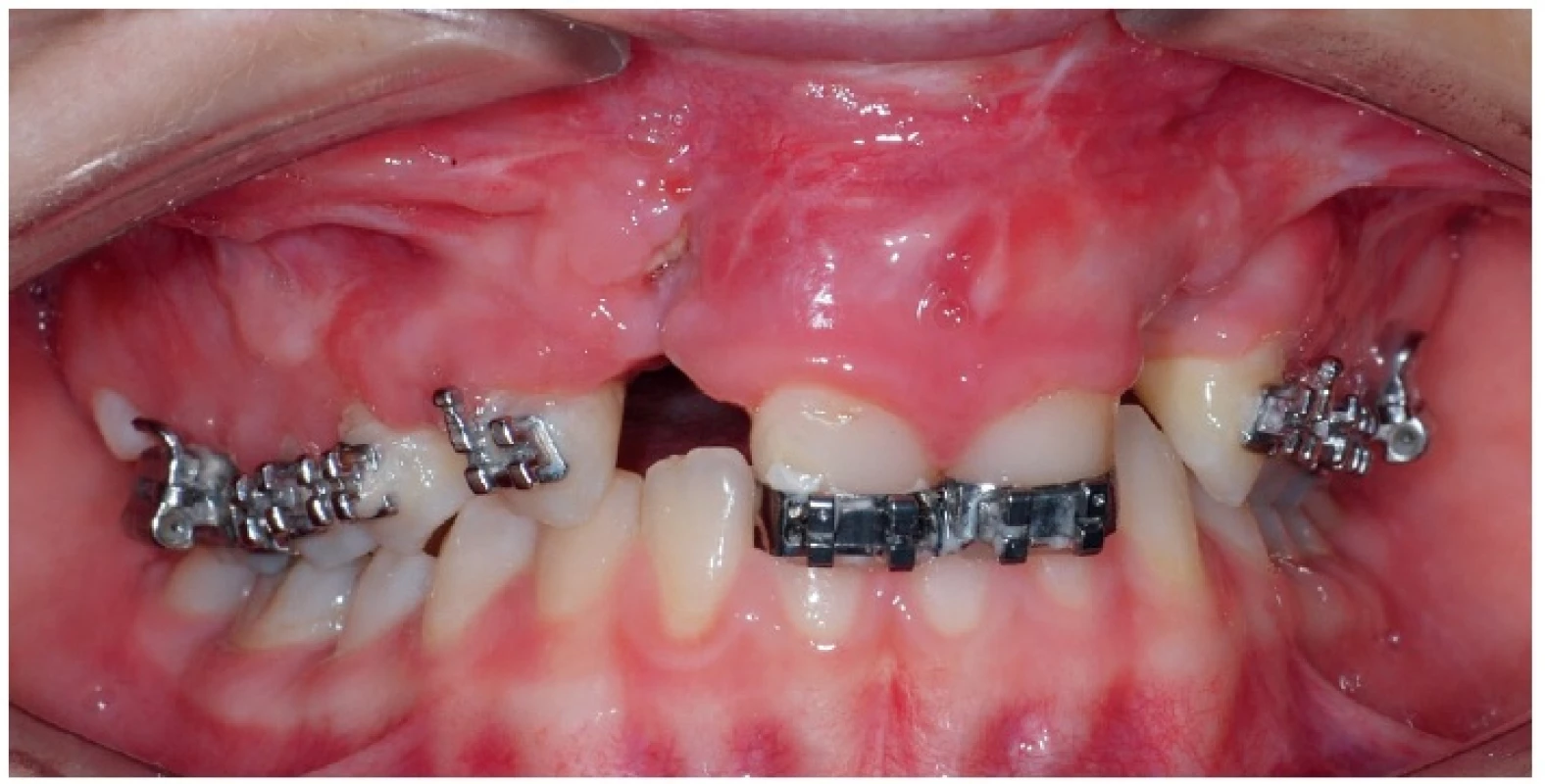 Příklad možných komplikací po chirurgické rekonstrukci alveolárního výběžku u dvanáctileté pacientky s oboustranným celkovým rozštěpem – 3 měsíce po výkonu je v místě operce viditelná malá dehiscence a zánět měkkých tkání, dochází k částečnému odhojování doplněného kostního materiálu. Fixní ortodontický aparát slouží pro stabilizaci čelistních segmentů, není prováděna aktivní ortodontická terapie. Pro účely fotodokumentace byl sejmut ortodontický oblouk