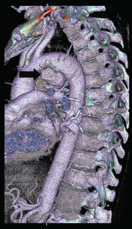 CTA obraz posttraumatickej pseudoaneuryzmy descendentnej aorty (šípka).
