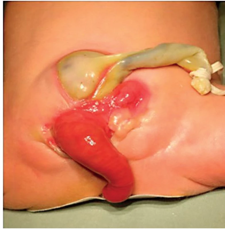 Nativní exstrofie kloaky s omfalokélou a protruzí pahýlu atretického colon.
Fig. 3. Cloacal exstrophy with omphalocele and protruding atretic colon.