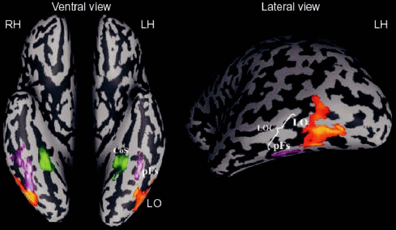 Počítačovým programem „rozbalená“ mozková kůra, pohled na vnitřní stranu pravé a levé hemisféry
RH… PH
LH… LH
Ventral view ventrální pohled
Lateral view laterální pohled
Vysvětlivky:
LOC laterální okcipitální komplex
pFs purpurová
LO oranžová;
jsou součásti LOC
CoS sulcus collateralis
Zeleně značená oblast odpovídá PPA, parahipokampální oblasti pro budovy (parahippocampal
place area)