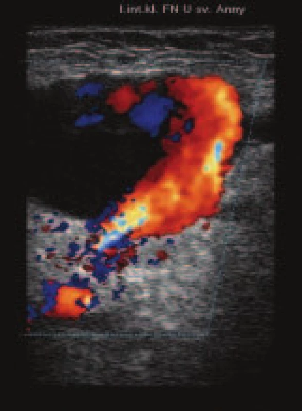 Duplexní ultrazvukové (UZ) vyšetření: dutina pseudoaneuryzmatu plněná arteriální krví.
