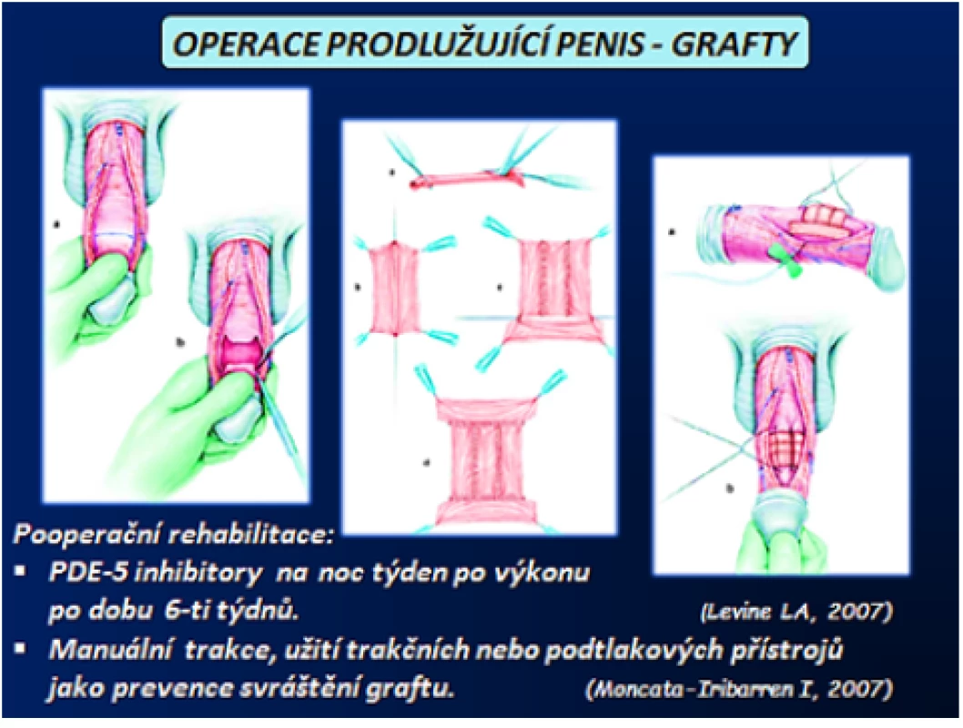 Operace prodlužující penis – veńozní graft (3) 
Fig. 15 Lengthening penis procedures – vein graft (3)
